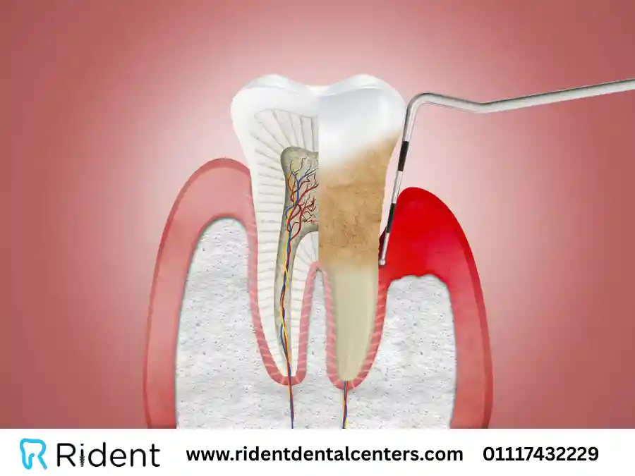 أهم أسباب التهاب اللثة الحاد وطرق التعافي منها